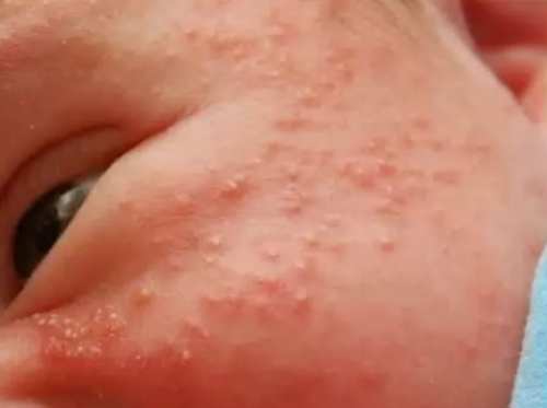 Инфекционные заболевания кожи и пупка ребенка thumbnail